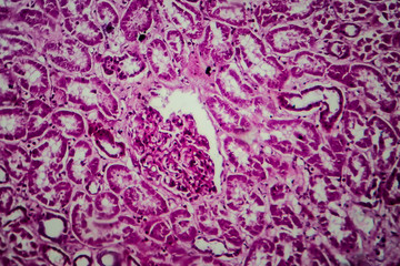 Obraz premium Diffuse sclerosing glomerulonephritis