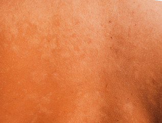 Sunburn on the skin of the back. Exfoliation, skin peels off. Dangerous sun tan