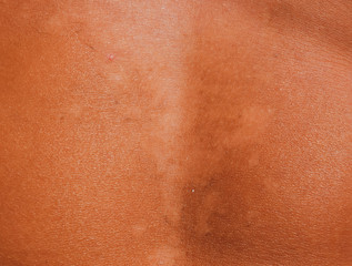 Fototapeta premium Sunburn on the skin of the stomach. Exfoliation, skin peels off. Dangerous sun tan