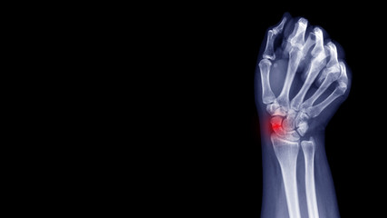 Film X-ray wrist radiograph show carpal bone broken (scaphoid fracture) from falling. Highlight on...