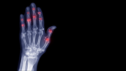 Film X-ray hand radiography show degenerative osteoarthritis disease(OA disorder). Patient has finger joint arthritis,pain and stiffness problem. Medical diagnosis technology and examination concept.