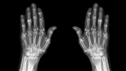 Film X ray hand radiography show degenerative osteoarthritis disease(OA disorder). Patient has...