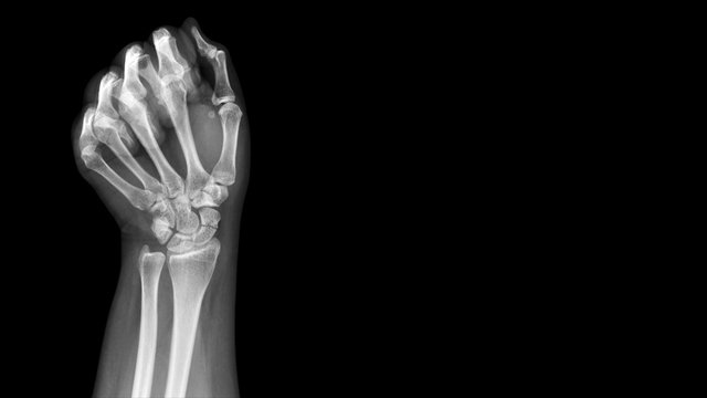 Film X ray wrist radiograph show show carpal bone broken (scaphoid fracture). The patient has wrist pain, swelling and deformity. Medical imaging and orthopedic technology concept