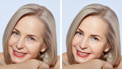 Middle age close up woman happy face before after cosmetic procedures. Skin care for wrinkled face. Before-after anti-aging facelift treatment. Facial skincare and contouring.