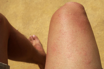 Rash on the legs is a symptom of hives skin caused by dust allergies or Allergy from dust PM 2.5