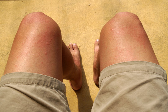 Rash on the legs is a symptom of hives skin caused by dust allergies or Allergy from dust PM 2.5