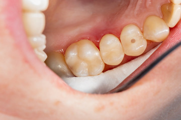 Obraz premium two chewing side teeth of the upper jaw after treatment of caries. Restoration of the chewing surface with a photopolymer filling material using the Rubber Dam system