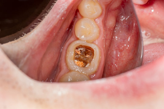 Caries And Tooth Disease. Filling With A Dental Composite Photopolymer Material Using Rubber Dam. The Concept Of Dental Treatment In The Dental Clinic