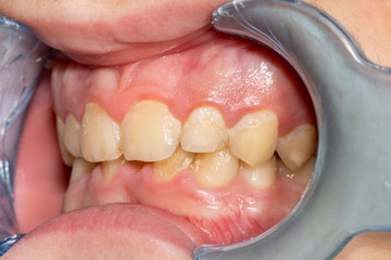 Obraz premium Close-up of macro dental calculus and dental plaque. Oral hygiene in dentistry