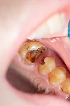 Caries And Tooth Disease. Filling With A Dental Composite Photopolymer Material Using Rubber Dam. The Concept Of Dental Treatment In The Dental Clinic