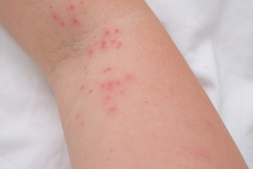 Fototapeta premium Skin rash on female arm, itchy pimples as a result of an allergic reaction, response, concept of allergy and dermatology