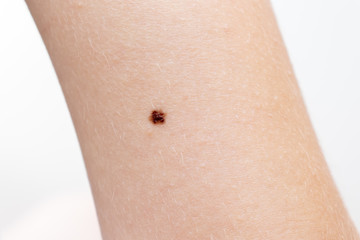 Nevus, neoplasm on the skin of an arm, dermatology and oncology treatment and surgery