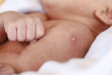  Close up of reaction of Bacillus Calmette Guerin or BCG vaccination infants.