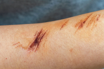 The wound form scabs on hand and arm. The wound happen during woman Injuries from falling down on road.