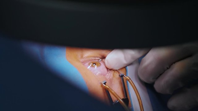 Woman's eye close-up. Laser beam on the cornea. Laser vision correction, ophthalmology. Photorefractive, Keratectomy