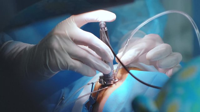 Laser vision correction. A patient and team of surgeons in the operating room during ophthalmic surgery. Eyelid speculum. Lasik treatment. Patient under sterile cover