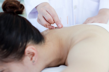 hand of doctor performing acupuncture therapy . Asian female undergoing acupuncture treatment with a line of fine needles inserted into the her body skin in clinic hospital
