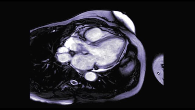 MRI heart or Cardiac MRI  magnetic resonance imaging  of heart in 3 chamber view showing left atrium ,left ventricle, mitral  and aortic valve  for detecting heart disease.
