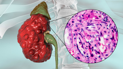 Chronic pyelonephritis, 3D illustration showing gross morphology with irregular scarred cortical surface and light micrograph showing interstitial fibrosis and inflammation
