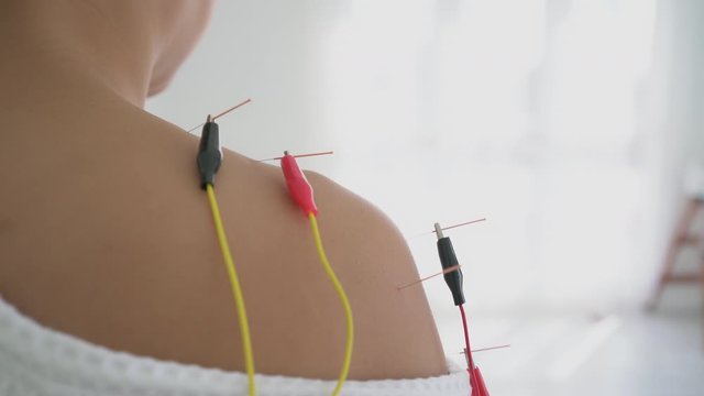 Close up asian woman Traditional Chinese and Electro acupuncture on body of patient at clinic Alternative medicine concept