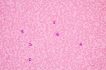 Human blood smear view in microscopy.Complete blood count for treatment. Polymorphonuclear...