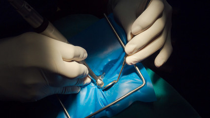 Close up dentist examining patient tooth on dental chair.Professional dentist making teeth cleaning patient at the dental office.Scaling limestone and tooth care concept.