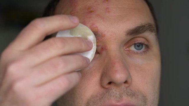 man with herpes zoster on his face treats purulent blisters with a cotton pad