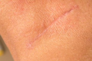 Fototapeta premium Suture after surgery on the human neck. The scar after the surgery. Close up.