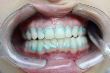 Obraz premium Teeth Whitening 