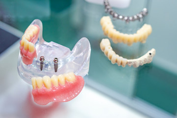 Removable acrylic denture. Work as a dentist. Prosthesis on mini implants. Equipment for the...
