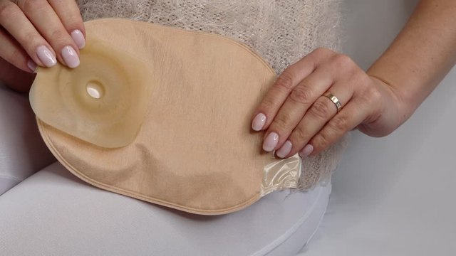 Colostomy bag, supply needed after colostomy surgery - colon cancer treatment. 2 piece ostomy bag in skin color. Medical theme. Stoma bag ready to use