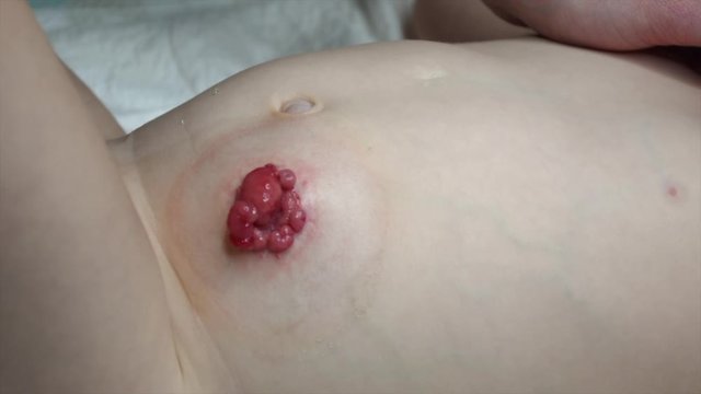 Close-up top view on colostomy on baby patient. Colostomy surgery.