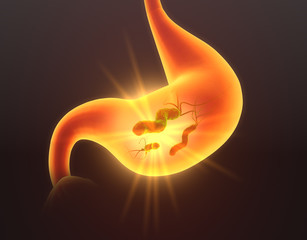 Gastritis, escherichia coli bacteria in stomach, medically concept, 3D illustration
