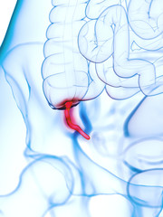 3d rendered medically accurate illustration of an inflamed appendix