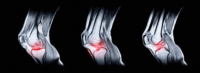 Magnetic resonance imaging (MRI) of right knee. Closed injury of the knee joint, with...