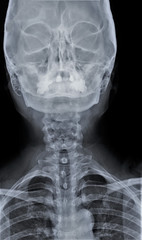 x-ray of the skull with the cervical spine