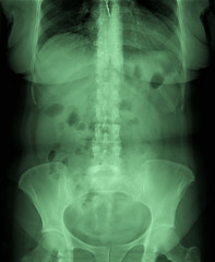 x-ray of the abdominal cavity and pelvis in direct projection, medical research,urography