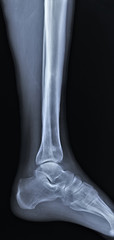  radiography of the ankle joint in the lateral projection