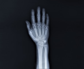 x-ray of hand bones, diagnosis of diseases
