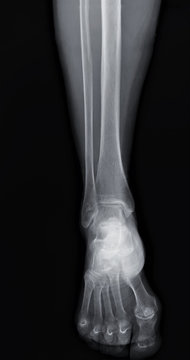 x-ray of the ankle joint in direct projection