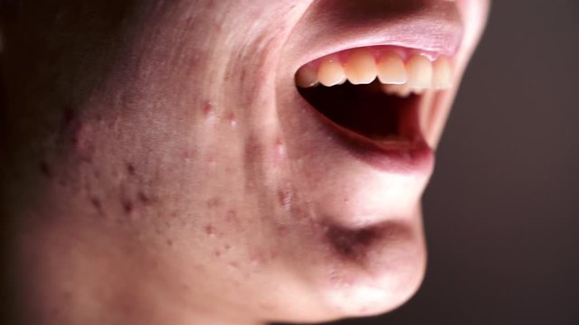 Skin problem - fake laughing and smiling - macro shot - Young Woman who suffers severe acne. Sarcasm