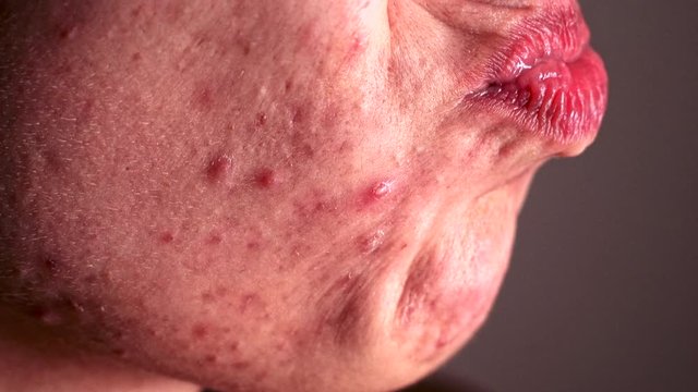 Skin problem - Young Lonely Woman who suffers severe acne - Macro - Sends air kisses and wanting to get a Kiss back.