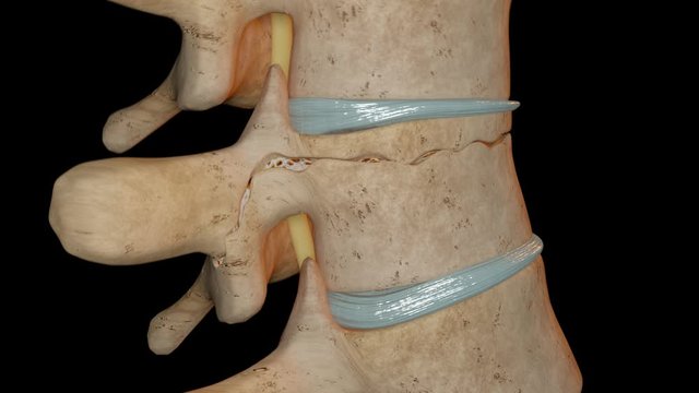 Flexion Distraction Fracture Of The Vertebra