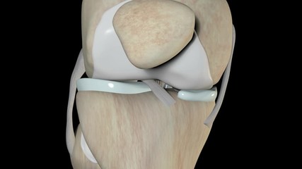Anterior Cruciate Ligament Rupture