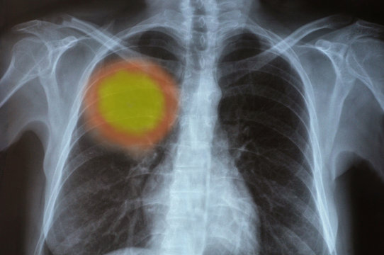 Radiographie d'un cancer 