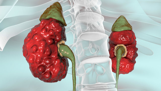Chronic pyelonephritis, 3D illustration showing irregular scarred cortical surface particularly at poles and dilated ureter