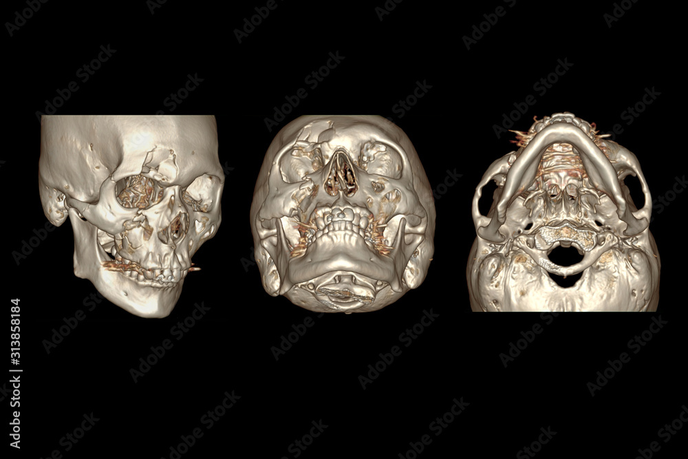 Poster ct facial bone 3d rendering image isolated on black background showing fracture frontal bone .