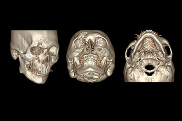 CT Facial Bone 3D rendering  image isolated on black background showing fracture frontal bone . © samunella