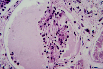 Acute glomerulonephritis, light micrograph