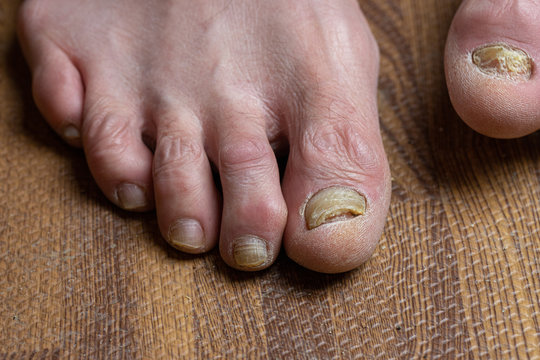 Curled toes on feet of Parkinson's Disease and fungi 